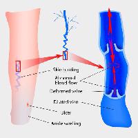 Pixwords Kuva iho, jalka, jalat, nilkka, veri, nuolet, lääketieteellinen, lääketiede Designua